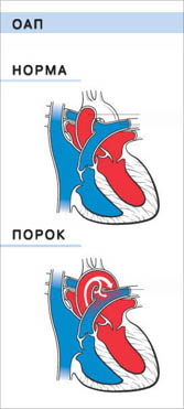 Открытый Артериальный Проток
