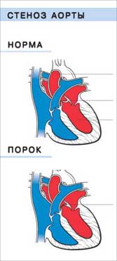 Порок сердца стеноз аорты