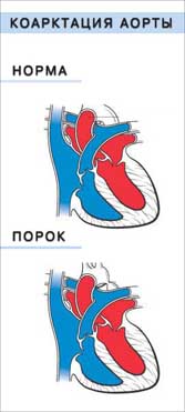 Коарктация аорты - врождённый порок сердца