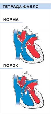 Порок сердца Тетрада Фалло