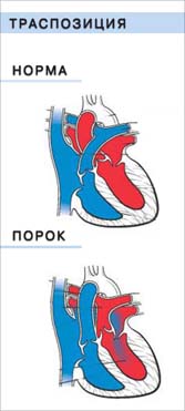 Порок сердца Транспозиция магистральных артерий