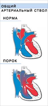 Порок сердца Общий артериальный ствол